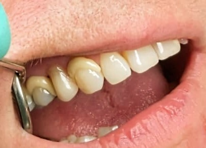 Snímatelná náhrada ACETAL 1