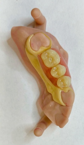 Snímatelná náhrada ACETAL 17