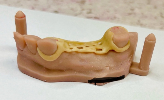 Snímatelná náhrada ACETAL 18