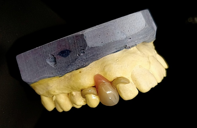 Snímatelná náhrada ACETAL 2