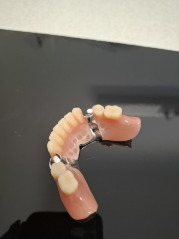 Snímatelná náhrada částečná skeletová