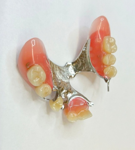 Částečná skeletová snímatelná náhrada s kovovým skeletem