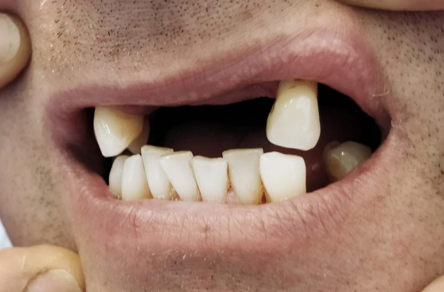 Deflexová náhrada 1