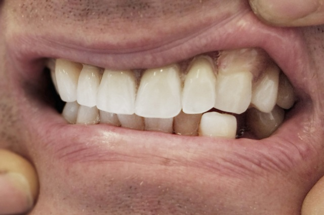 Deflexová náhrada 2