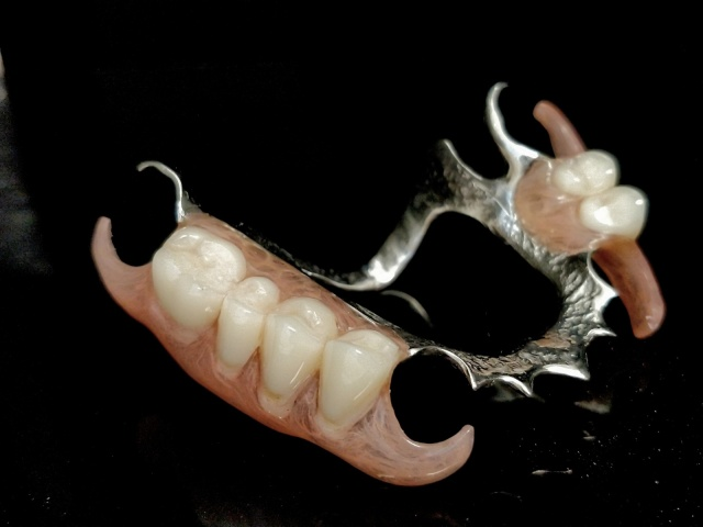 Skeletová náhrada kombinace kov a deflex 2