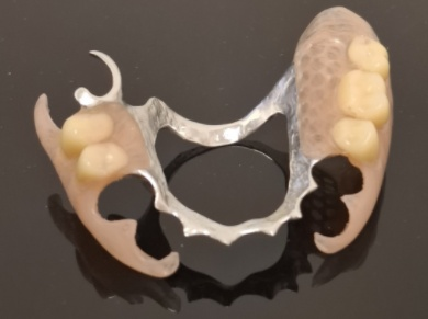 Skeletová náhrada kombinace kov a deflex 3