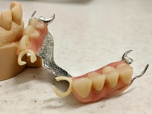 Skeletová náhrada kombinace kov a Zirlux ACETAL 1