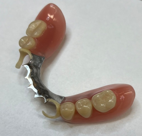 Skeletová náhrada kombinace kov a Zirlux ACETAL 2