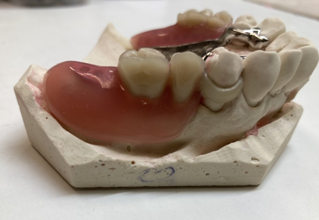 Skeletová náhrada kombinace kov a Zirlux ACETAL 3