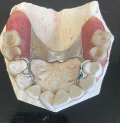 Skeletová náhrada kombinace kov a Zirlux ACETAL 4
